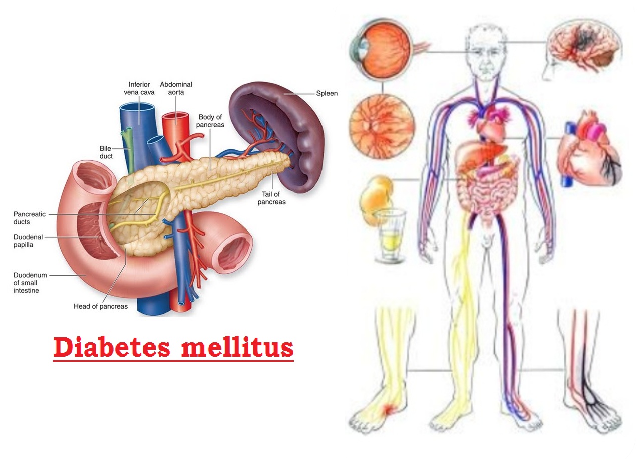 Diabetes mellitus