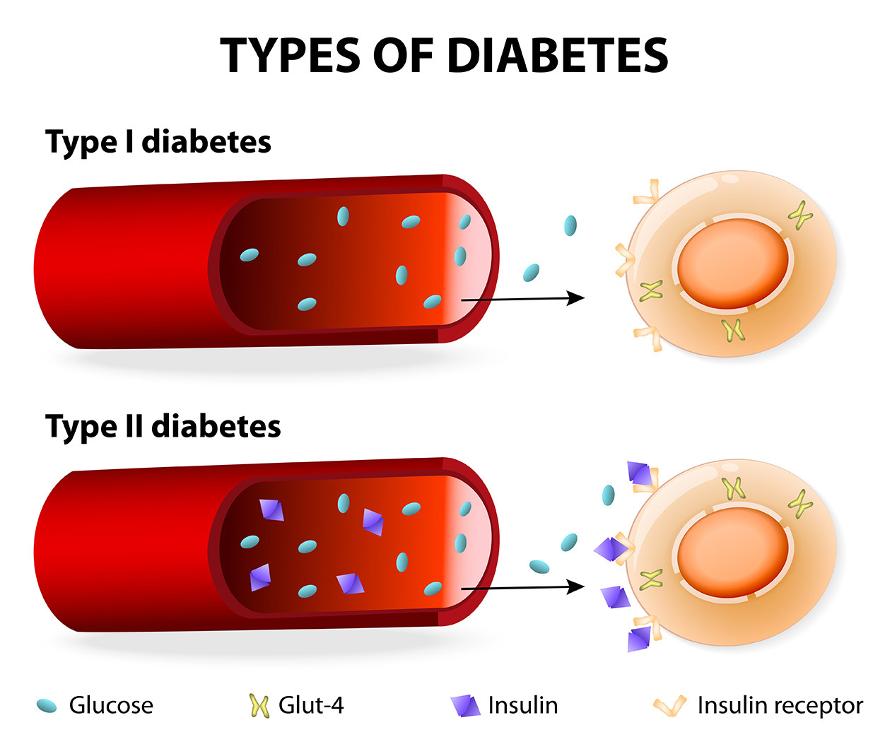 Diabetes mellitus